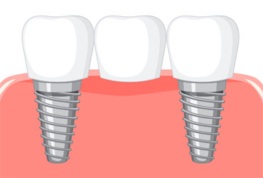 dental-implant-in-panvel-at-affordable-cost-vicahre-dental-clinic