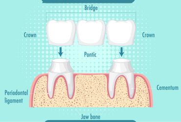crown-and-bridges-treatment-in-panvel-vichare-dental-clinic