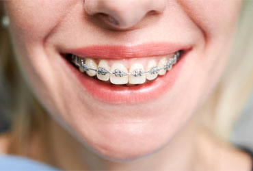 orthodontics-treatment-in-panvel-at-vicahre-dental-clinic
