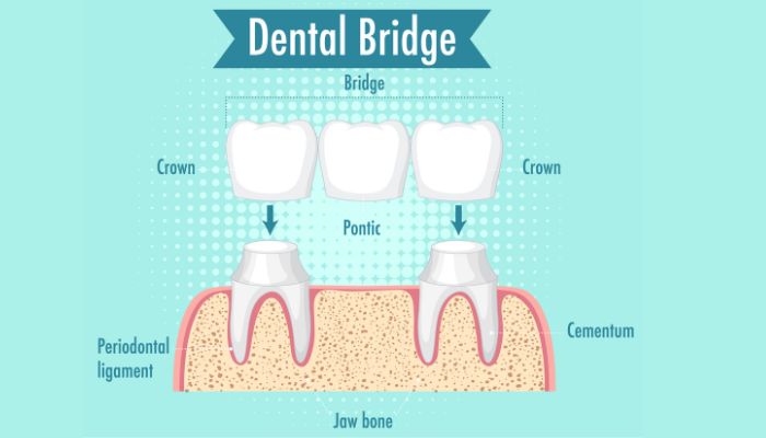 best dental clinic for crown and bridges center in panvel vichare dental clinic